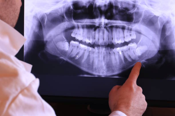 Best Emergency Root Canal Treatment in Balfour, NC